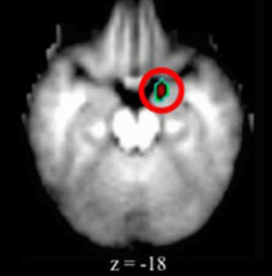 Photo of brain scan showing elevated amygdala levels in children with depression