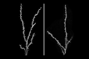 (Left) Excess synapses in the brain of a child with autism (Right) Properly pruned synapses of a developmentally typical child. Credit: Guomei Tang/Mark S. Sonders/Columbia University Medical Center